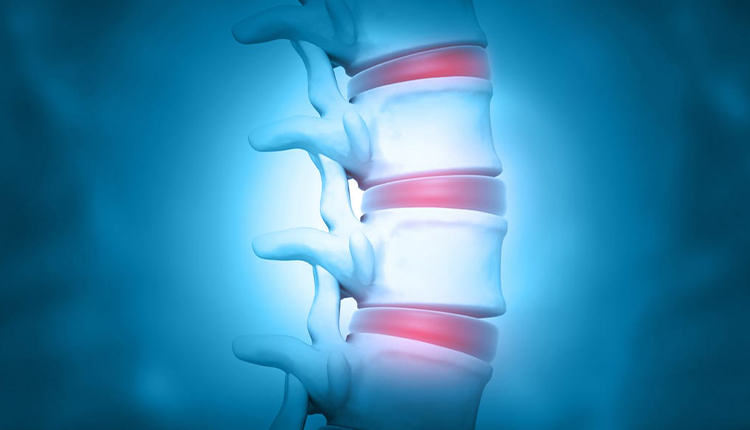 HERNIATED DISC SURGERY