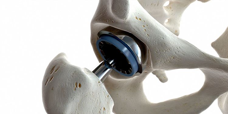 HIP REPLACEMENT at Milad hospital in khoy
