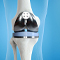 KNEE REPLACEMENT IN MILAD HOSPITAL AT KHOY CITY