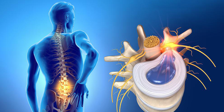 Surgery for a herniated disc at Milad Hospital