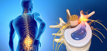جراحی فتق دیسک در بیمارستان شمس