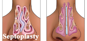 ed Septum Surgery) Septoplasty (Deviat at  milad hospital in Khoy
