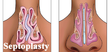 ed Septum Surgery) Septoplasty (Deviat at  milad hospital in Khoy