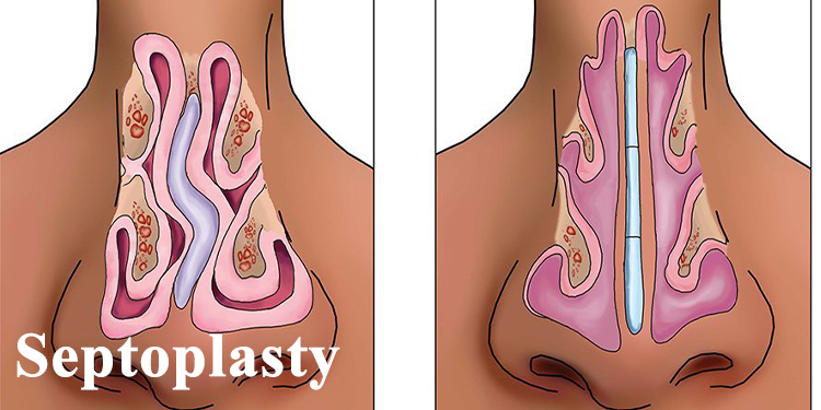 ed Septum Surgery) Septoplasty (Deviat at  milad hospital in Khoy