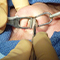 ed Septum Surgery) Septoplasty (Deviat at  milad hospital in Khoy