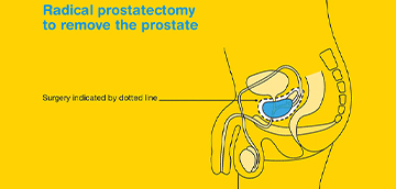 laparoscopic-prostate-surgery-IN-MILAD-KHOY-HOSPITAL