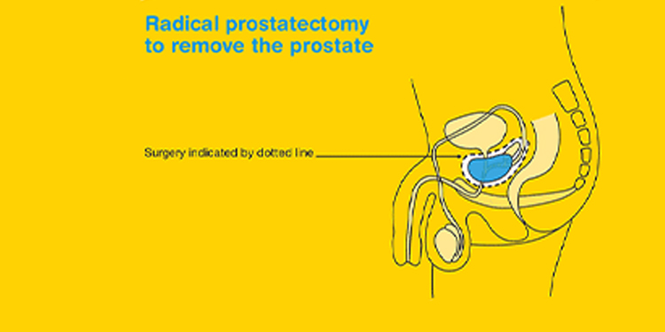 laparoscopic-prostate-surgery-IN-MILAD-KHOY-HOSPITAL
